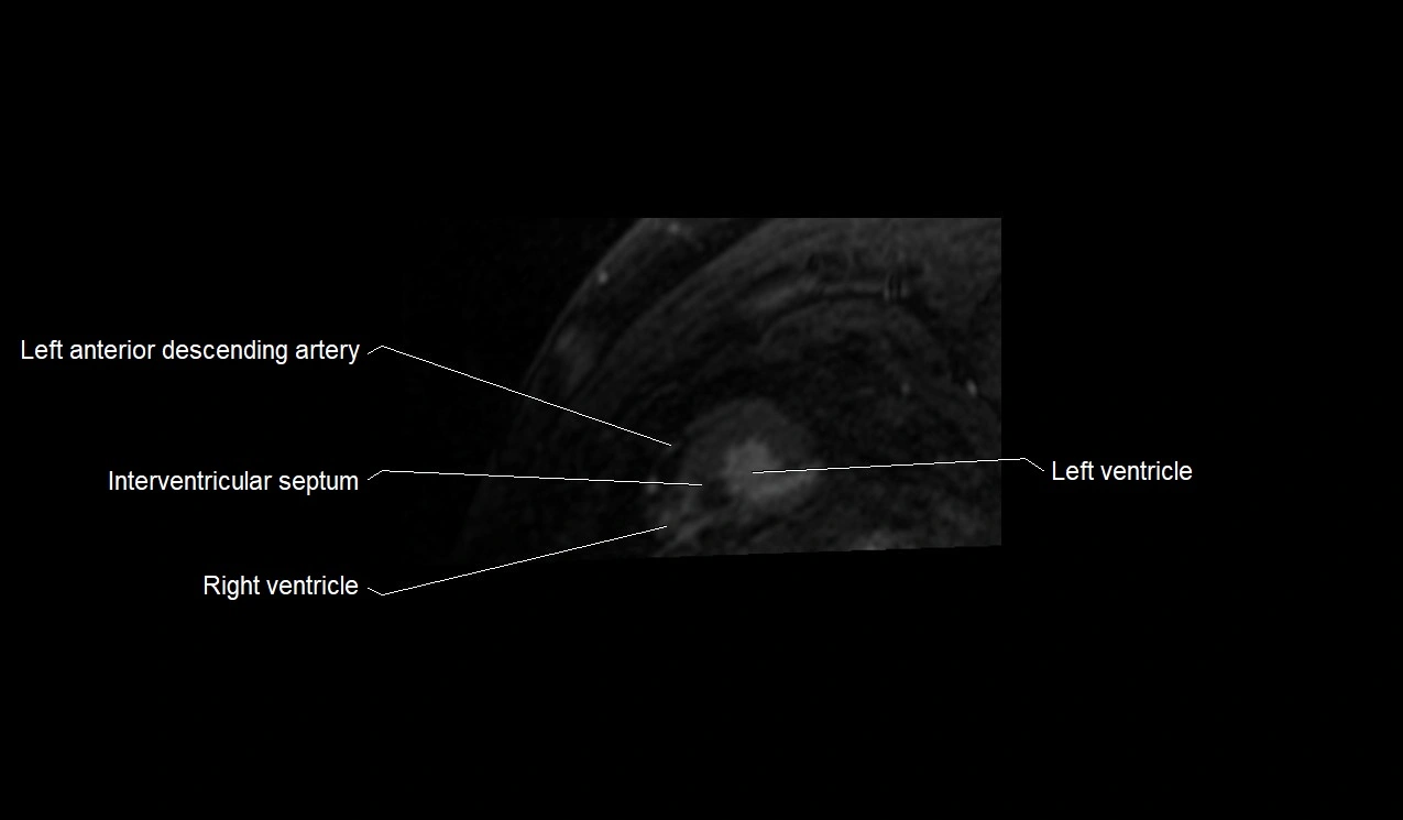 MRI heart and coronary arteries short axis anatomy image 39.webp